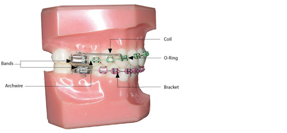 Martin Orthodontics How Braces Work