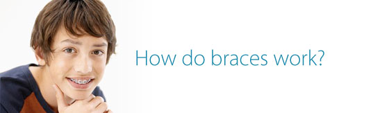 Martin Orthodontics Bergen County orthodontist How Braces Work image