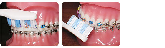 Martin Orthodontics Bergen County orthodontist Brushing and Flossing Step 2